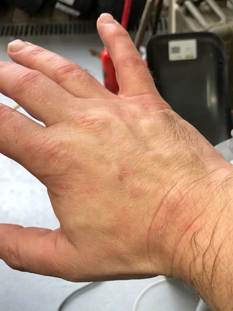 Brake Fluid on Skin